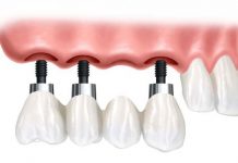 Технологии имплантации зубов: от классики до инноваций имплантации зубов